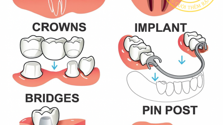 Các câu hỏi thường gặp về phục hình răng sứ?