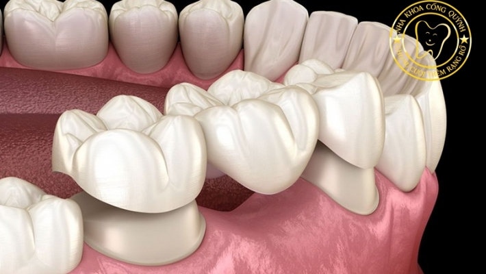 Khi nào cầu răng không còn là giải pháp phù hợp