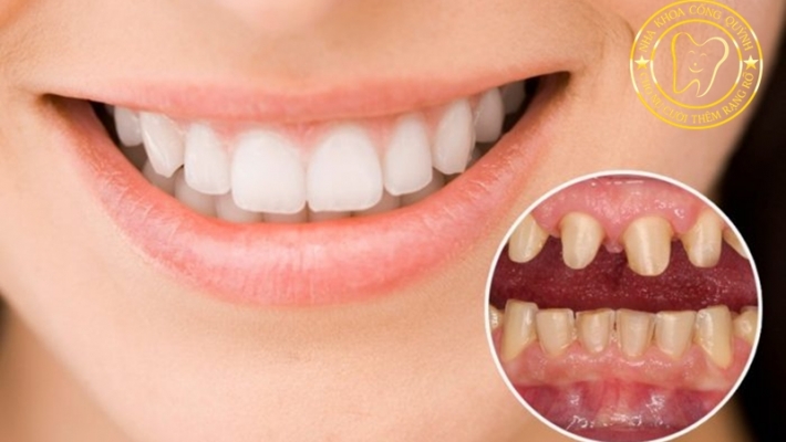 Quy trình phục hình răng sứ tại Nha Khoa Cống Quỳnh