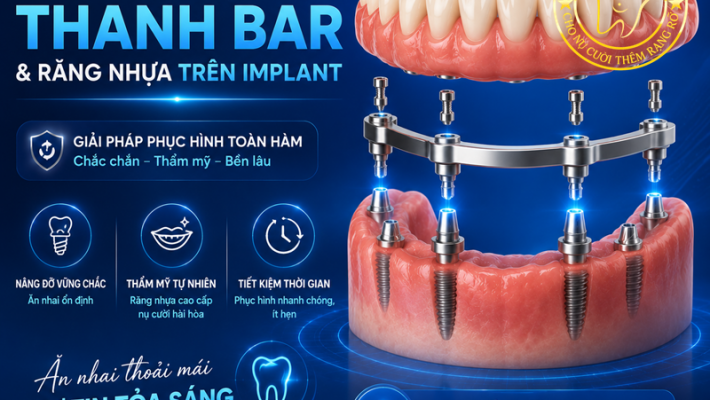Hàm toàn bộ thanh bar và răng nhựa trên Implant Quận 1 tại Nha Khoa Cống Quỳnh