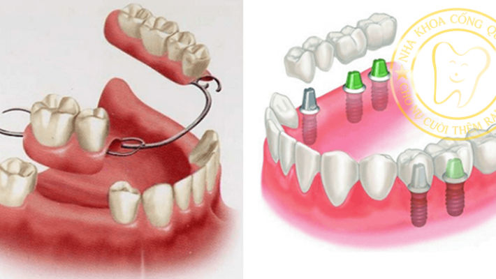 Khi nào nên chọn hàm tháo lắp thay vì Implant?