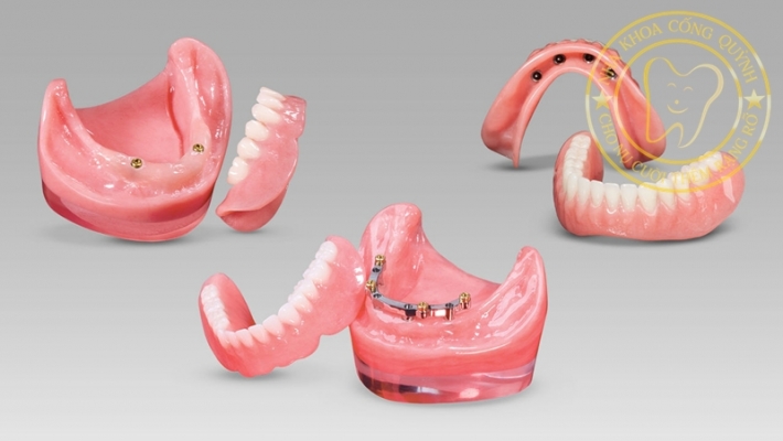 Hàm giả tháo lắp có ăn nhai tốt không?
