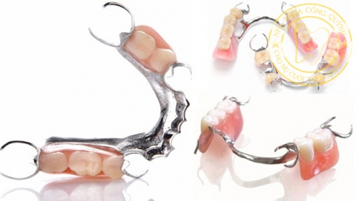 Hàm tháo lắp toàn phần và bán phần: Nên chọn loại nào?