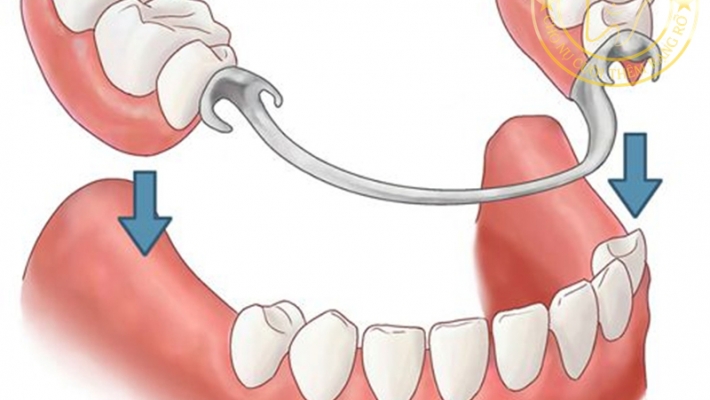 Phục hình tháo lắp có gây hôi miệng không? Cách khắc phục hiệu quả