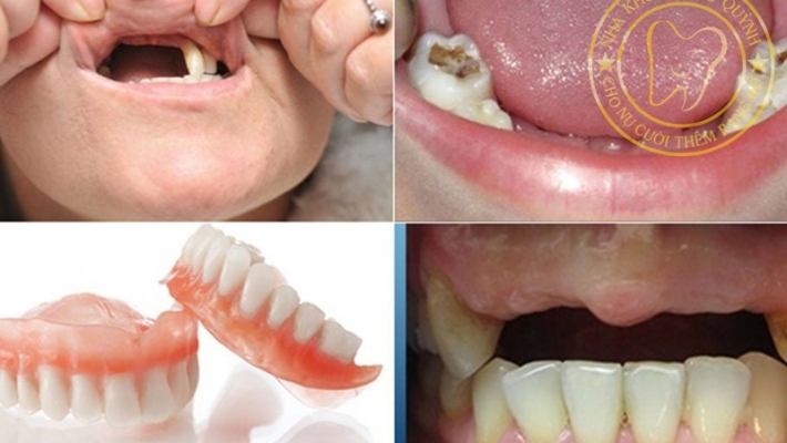 Quy trình làm hàm tháo lắp cho người mất răng nhiều