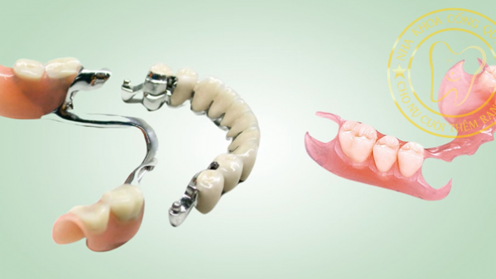 Hàm tháo lắp nhựa và hàm khung kim loại – khác nhau như thế nào?