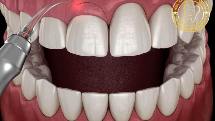 Phẫu thuật cắt nướu – Điều trị nha chu