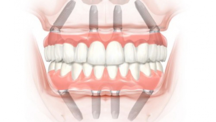 Cấy ghép implant All-on-4 