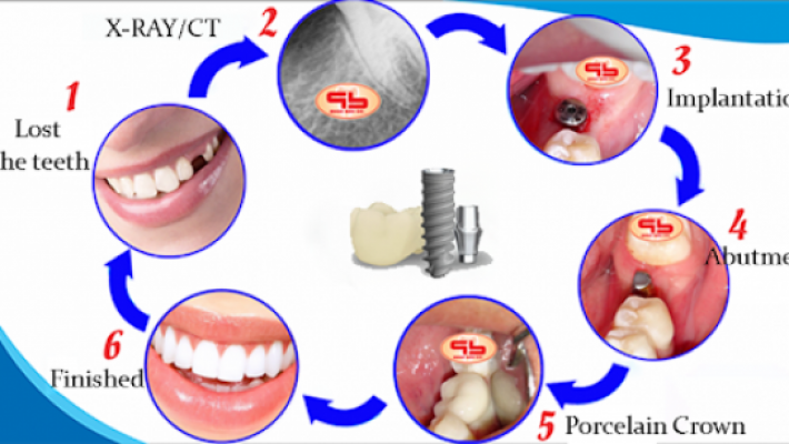 QUY TRÌNH CẤY GHÉP IMPLANT