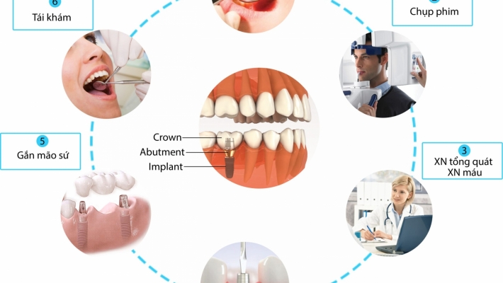Quy trình cấy ghép Implant tại Nha Khoa Cống Quỳnh