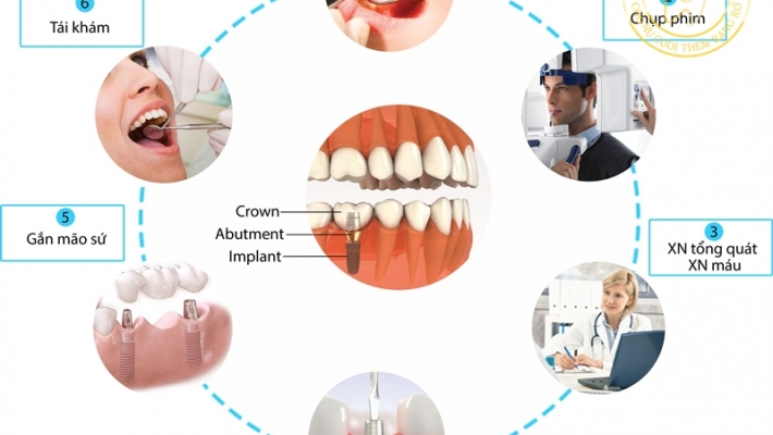 Quy trình cấy ghép Implant chuẩn Bộ Y Tế diễn ra như thế nào?
