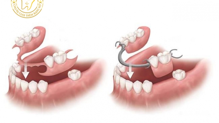 Phục hình tháo lắp hay răng sứ cố định – Nên chọn loại nào?