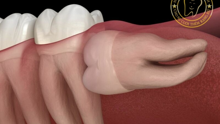 Phẫu thuật cắt lợi trùm răng khôn: Có cần thiết không?