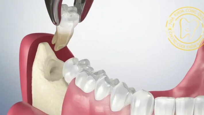 Nhổ răng khôn tiểu phẫu: Khi nào cần thực hiện và chi phí bao nhiêu?