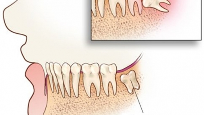 Khi nào cần nhổ răng khôn? Dấu hiệu răng khôn nguy hiểm