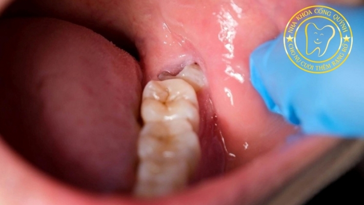 Răng khôn mọc lệch đâm má – xử lý thế nào?