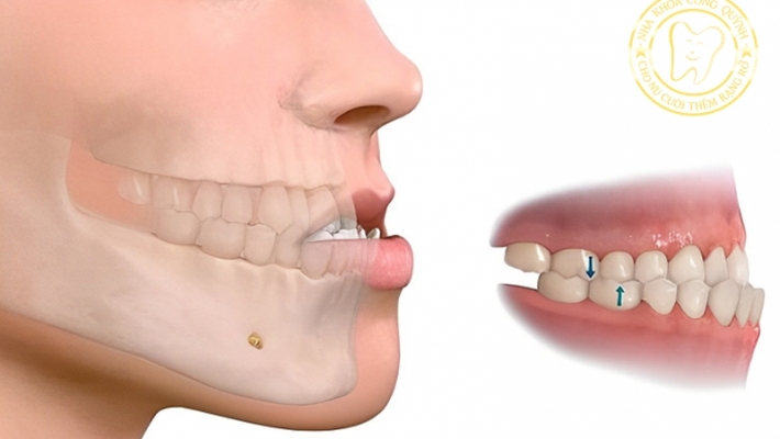 Những trường hợp KHÔNG nên niềng răng