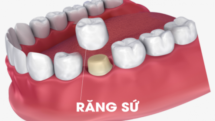 Phục hình răng sứ