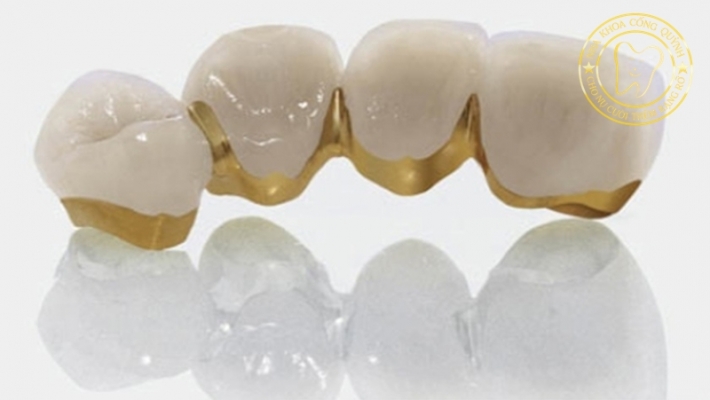 Răng sứ Au-Pt (vàng – bạch kim): Dành cho ai và có đáng đầu tư?
