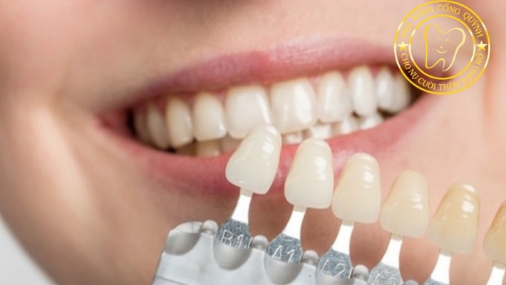Răng sứ có bị xỉn màu theo thời gian không? Cách giữ răng trắng lâu