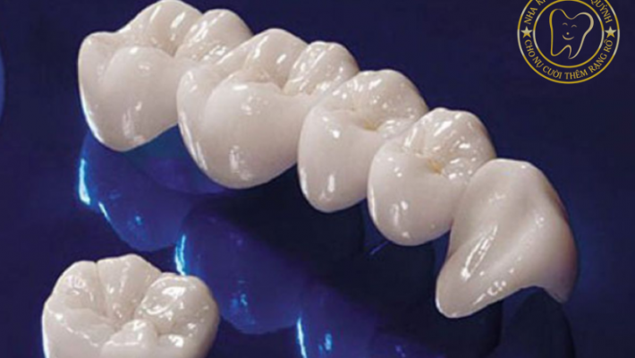 Quy trình bọc răng sứ đúng chuẩn hạn chế mài răng