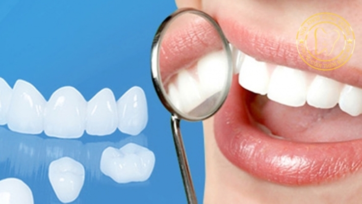 Làm răng sứ có bền không? Bao lâu phải thay mới?