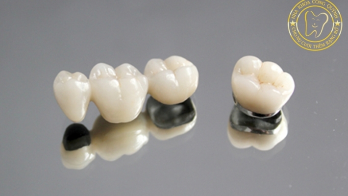 So sánh răng sứ Titan và Ni-Cr: Nên chọn loại nào để phục hình răng hàm?