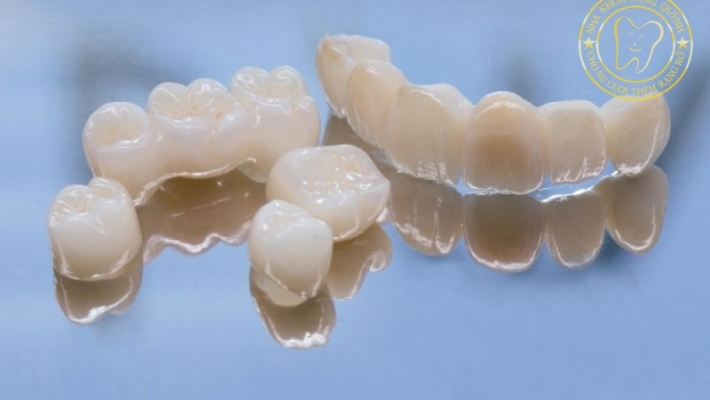 So sánh răng toàn sứ và răng sứ kim loại – loại nào phù hợp?