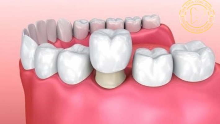 Phục hình răng sứ là gì?
