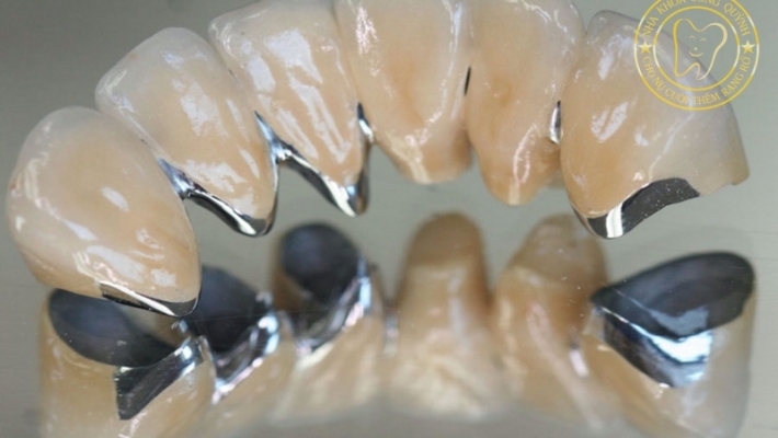 Răng sứ (khung sườn Au-Pt)