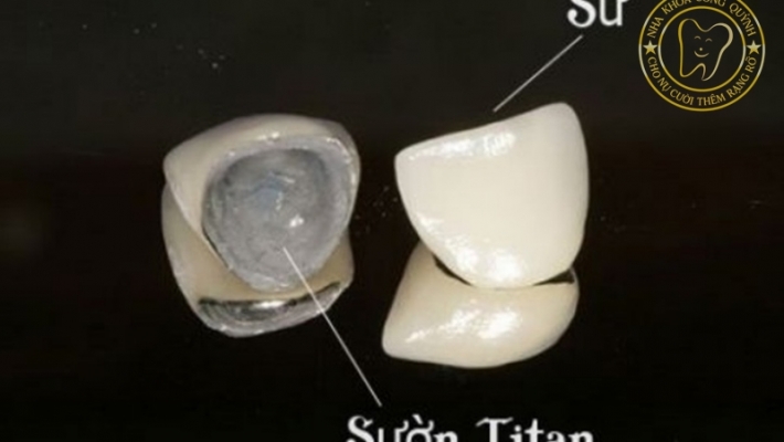 Răng sứ Titan có bị đen viền nướu không? Giải đáp từ bác sĩ