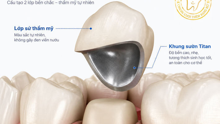Răng sứ khung sườn Titan – Phục hình răng sứ bền chắc