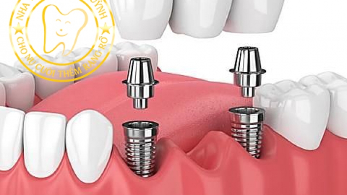 Răng sứ trên Implant – Giải đáp thắc mắc thường gặp từ chuyên gia