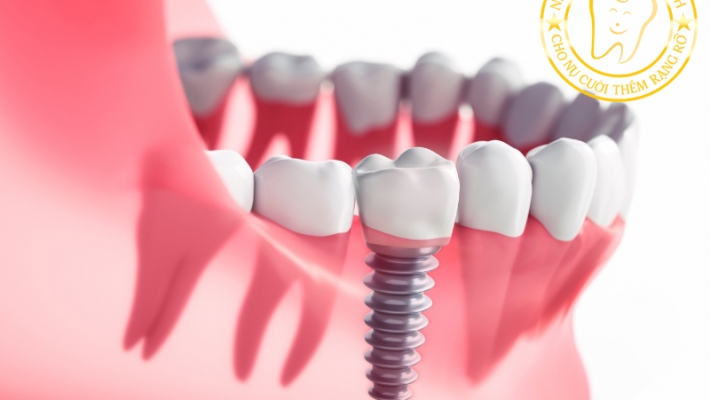 Răng sứ trên Implant – Giải đáp thắc mắc thường gặp