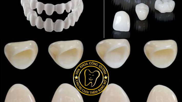 Các loại mão sứ thường dùng trên Implant: sứ kim loại, toàn sứ, Zirconia