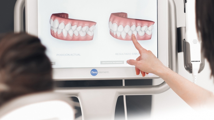 CÔNG NGHỆ SCAN 3D iTero – Trải nghiệm chuẩn xác cho khách hàng chỉnh nha Invisalign tại Nha Khoa Cống Quỳnh