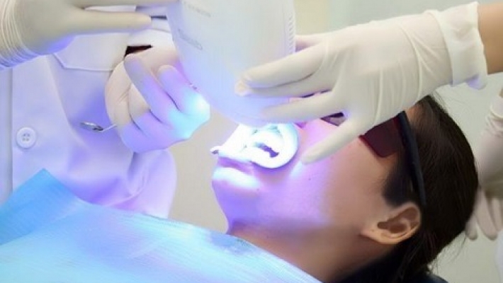 Tẩy trắng tại phòng nha chiếu đèn