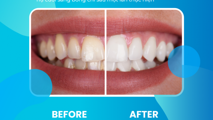 LÀM TRẮNG RĂNG ĐÓN TẾT – NHẬN QUÀ XỊN TẠI NHA KHOA CỐNG QUỲNH