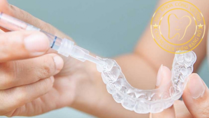 Máng tẩy trắng răng tại nhà: Hướng dẫn sử dụng và lưu ý quan trọng