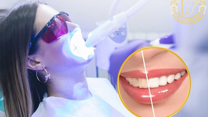 Tẩy trắng răng tại phòng nha chiếu đèn Quận 1