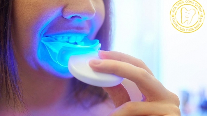 Hướng dẫn sử dụng an toàn Tẩy trắng răng tại nhà bằng máng