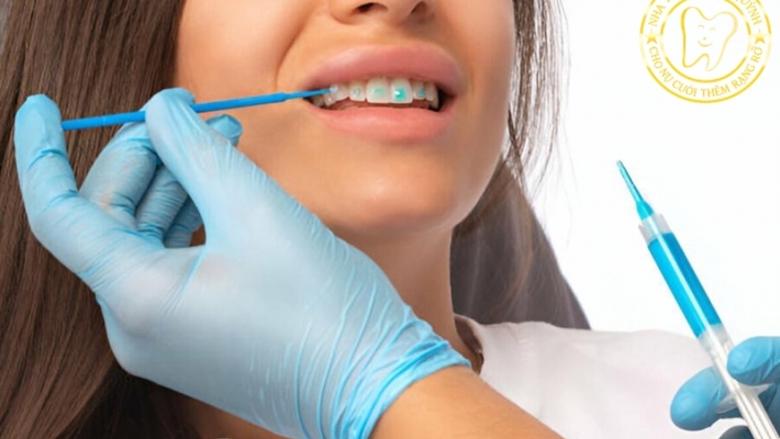 Làm trắng răng có an toàn không? Ai nên – ai không nên?