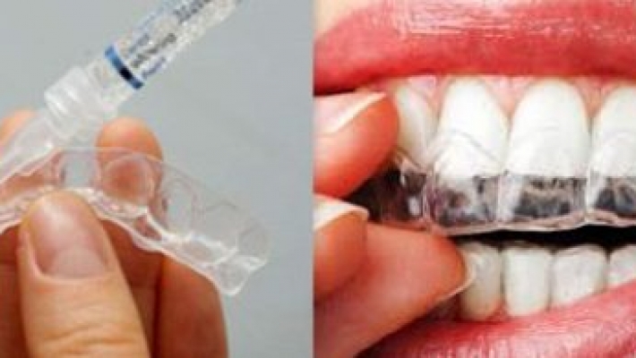 Tẩy trắng kết hợp