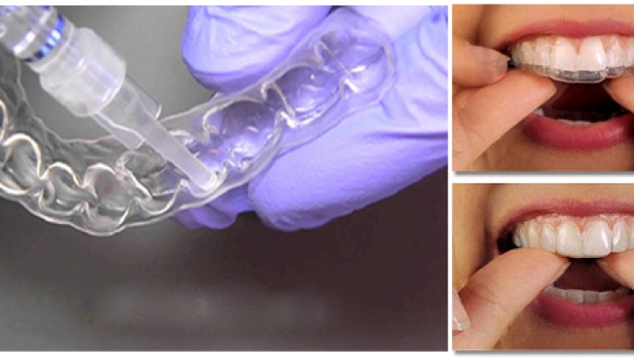 Các câu hỏi thường gặp về tẩy trắng răng?