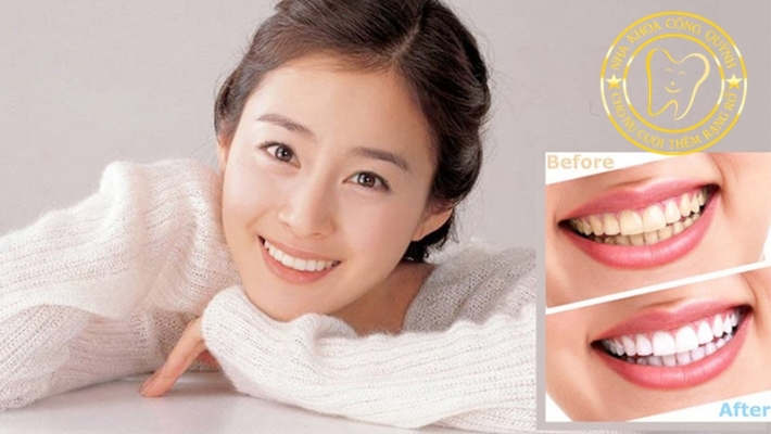 Giáo viên, MC, người giao tiếp nhiều nên tẩy trắng răng