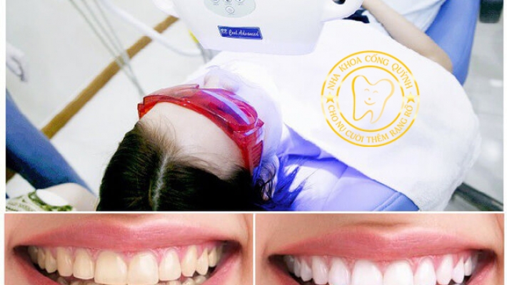 Tẩy trắng răng công nghệ đèn lạnh – Nụ cười sáng rạng rỡ chỉ sau 1 giờ