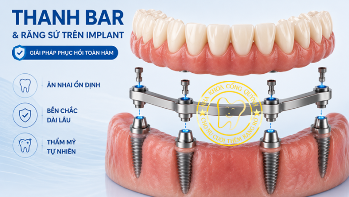 Hàm toàn bộ thanh bar và răng sứ trên Implant Quận 1 tại Nha Khoa Cống Quỳnh