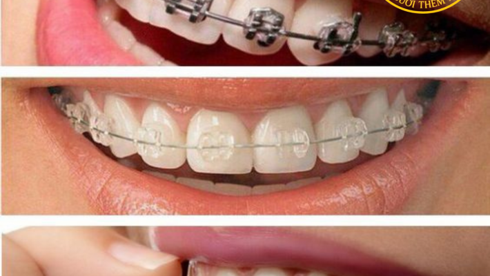 Niềng răng mắc cài và khay trong suốt: nên chọn loại nào?