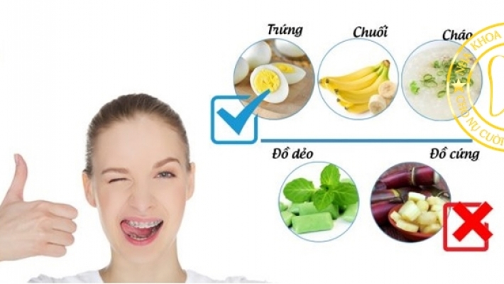Chăm sóc răng khi niềng: ăn gì, tránh gì?