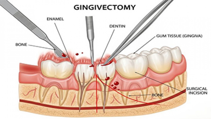 Nạo túi, xử lý bề mặt gốc răng